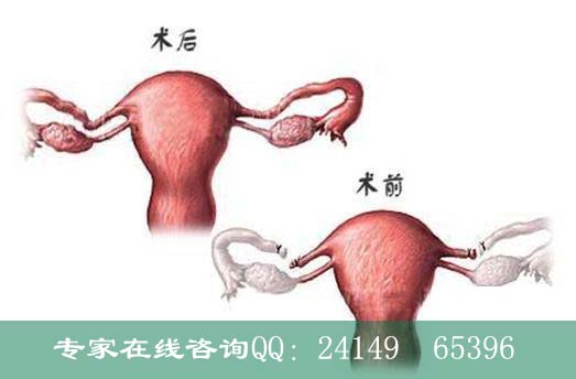 宁波那个医院做<em>输卵管</em>吻合术好_临汾新闻网