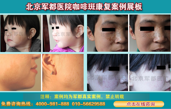 全国治疗咖啡斑哪家医院好