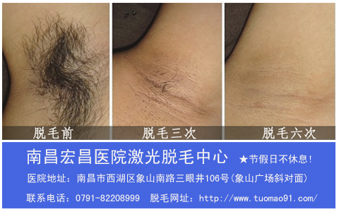 南昌激光脱毛哪家医院好zhongxin