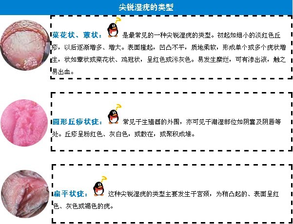 郑州尖锐湿疣<em>治疗</em>医院哪家专业_临汾新闻网
