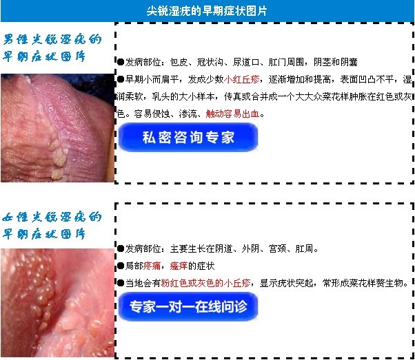 郑州<em>尖锐</em>湿疣药物能治疗吗_临汾新闻网