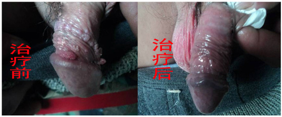 郑州尖锐湿疣的医院_临汾新闻网