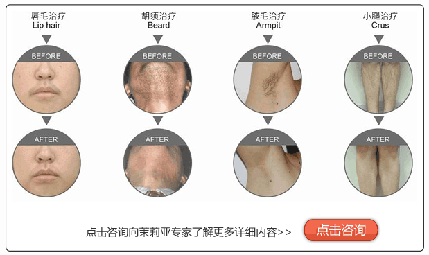 漯河哪可以冰点激光脱毛?