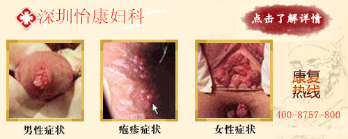 深圳梅毒的早期<em>症状</em>_临汾新闻网