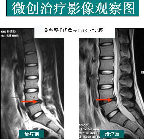 颈椎压迫神经有什么症状表现