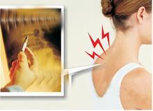 颈椎压迫神经有什么症状表现